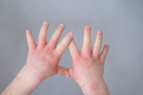 Nurturing Eczema-Prone Skin in Children: A Holistic Approach